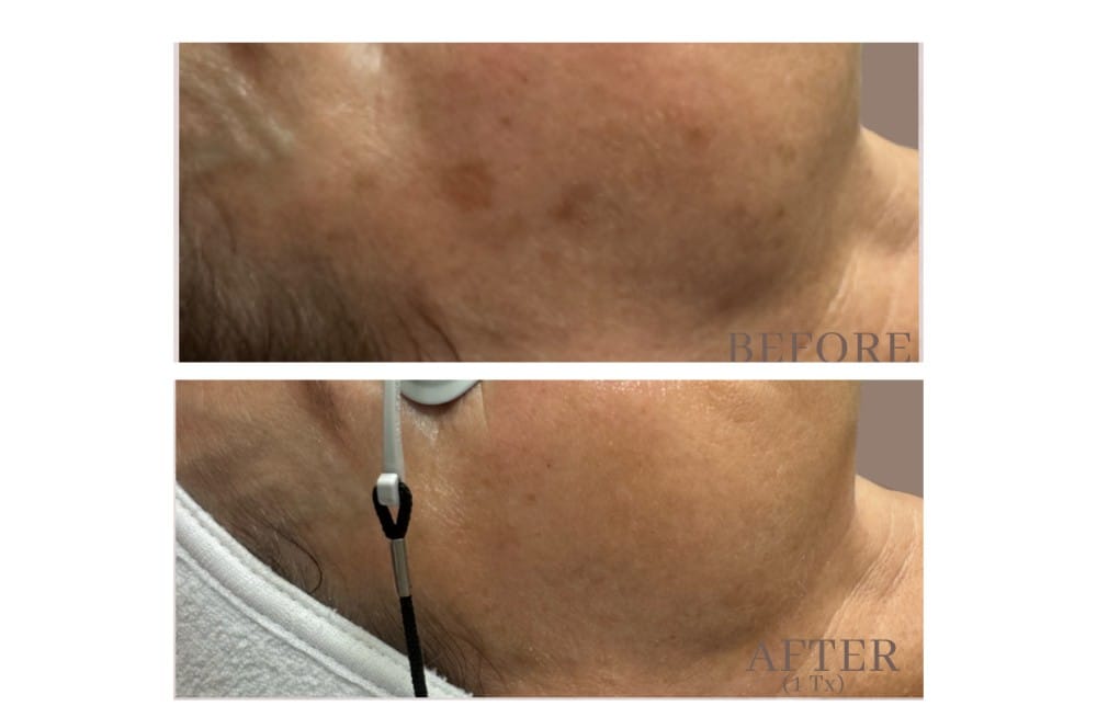 Before and after PicoLazer treatment showing reduced pigmentation and sun spots on the neck
